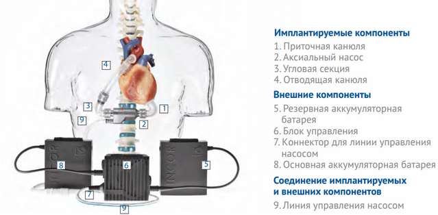 INCOR® LVAD